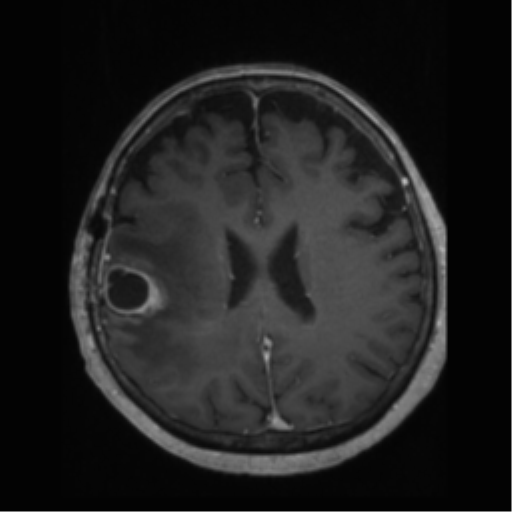 File:Anaplastic astrocytoma IDH wild-type (pseudoprogression) (Radiopaedia 42209-45277 Axial T1 C+ 80).png