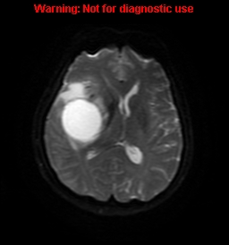 File:Anaplastic ganglioglioma (Radiopaedia 44921-48831 Axial DWI 48).jpg