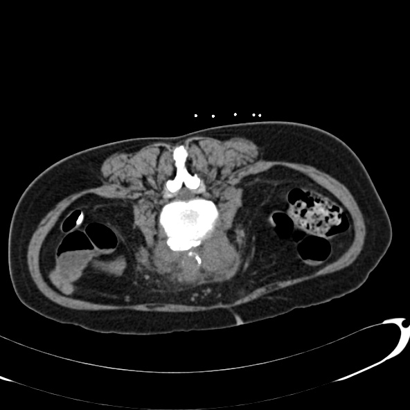 File:Anaplastic lymphoma - with CT biopsy (Radiopaedia 21643-21602 Axial non-contrast 49).jpg