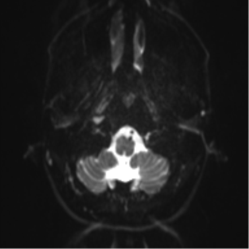 Anaplastic oligodendroglioma (Radiopaedia 37667-39563 Axial DWI 3).png