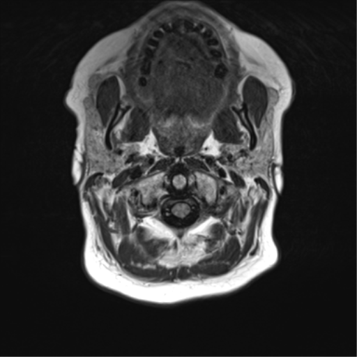 File:Anaplastic oligodendroglioma (Radiopaedia 83500-98599 Axial FLAIR 1).png