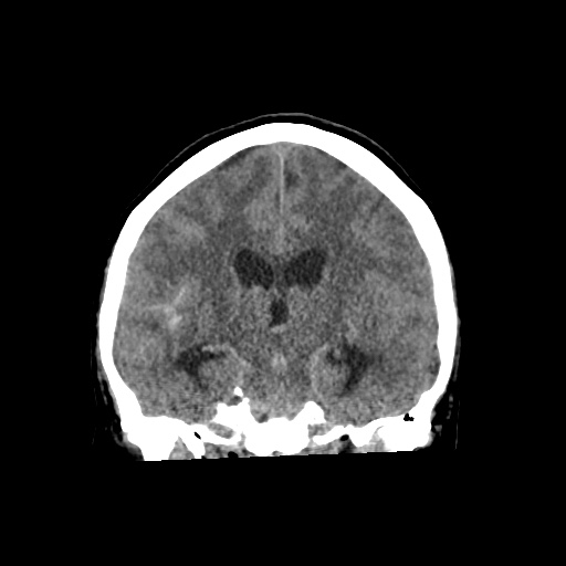 Aneursym related subarachnoid hemorrhage with hydrocephalus (Radiopaedia 45105-49083 Coronal non-contrast 34).jpg