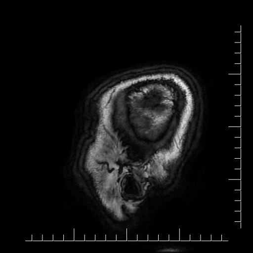 Aneurysm of posterior communicating artery (Radiopaedia 20188-20163 Sagittal T1 1).jpg