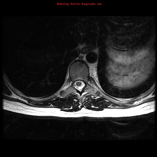 File:Aneurysmal bone cyst (Radiopaedia 9419-10103 Axial T2 7).jpg