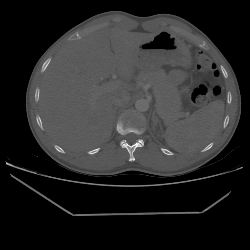 Aneurysmal bone cyst - rib (Radiopaedia 82167-96220 Axial bone window 246).jpg