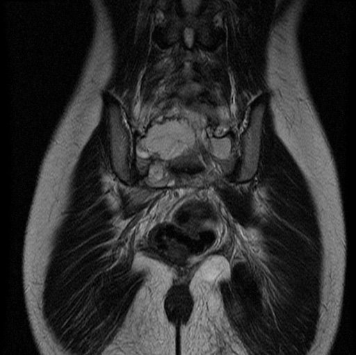 File:Aneurysmal bone cyst - sacrum (Radiopaedia 65190-74196 Coronal T2 10).jpg