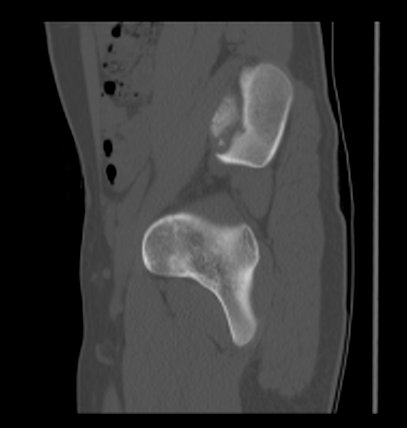 Aneurysmal bone cyst of ischium (Radiopaedia 25957-26094 Sagittal bone window 25).png