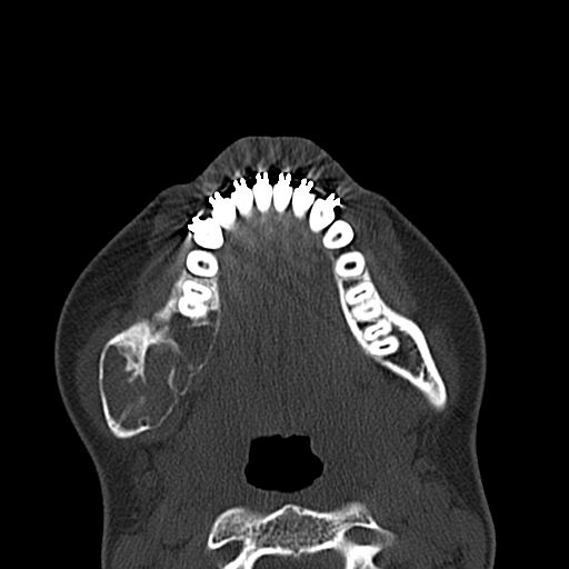 Aneurysmal bone cyst of the mandible (Radiopaedia 43280-46601 Axial bone window 26).jpg