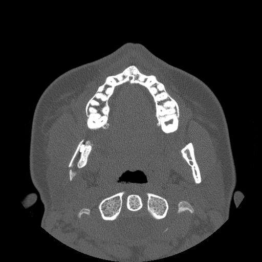 Aneurysmal bone cyst of the mandible (Radiopaedia 43280-46823 Axial bone window 86).jpg