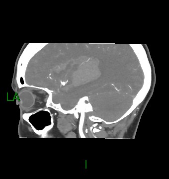 Aneurysmal subarachnoid hemorrhage with intra-axial extension (Radiopaedia 84371-99732 B 49).jpg