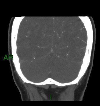 File:Aneurysmal subarachnoid hemorrhage with intra-axial extension (Radiopaedia 84371-99732 C 24).jpg