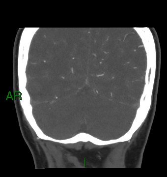 Aneurysmal subarachnoid hemorrhage with intra-axial extension (Radiopaedia 84371-99732 C 25).jpg