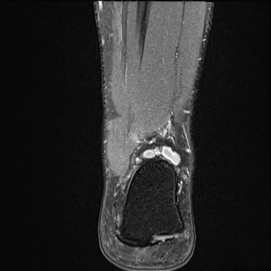 Ankle syndesmotic injury (Radiopaedia 69066-78837 Coronal PD fat sat 15).jpg