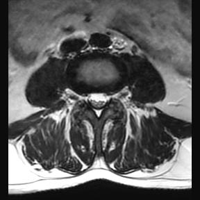 File:Ankylosing spondylitis with zygapophyseal arthritis (Radiopaedia 38433-40516 Axial T2 10).jpg