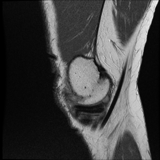 Anomalous insertion of the medial meniscus (Radiopaedia 77559-89721 Sagittal PD 45).jpg