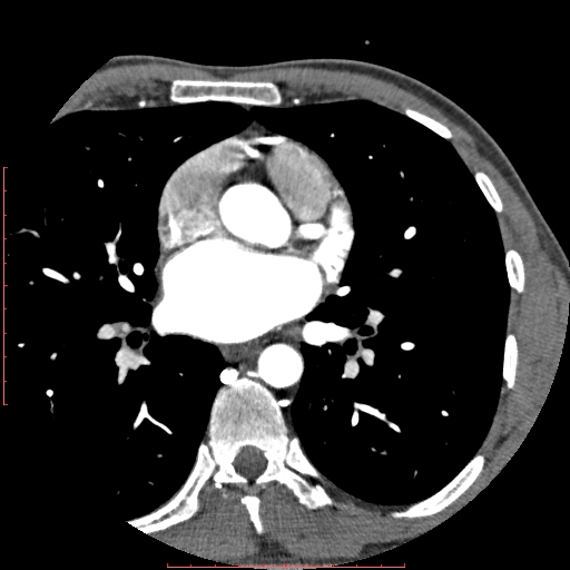 File:Anomalous left coronary artery from the pulmonary artery (ALCAPA) (Radiopaedia 70148-80181 A 108).jpg
