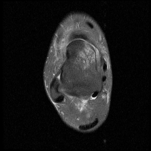 File:Anterior calcaneal process fracture (Radiopaedia 71377-81705 Axial PD fat sat 8).jpg