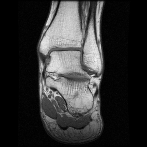 File:Anterior calcaneal process fracture (Radiopaedia 74654-85611 Coronal T1 14).jpg