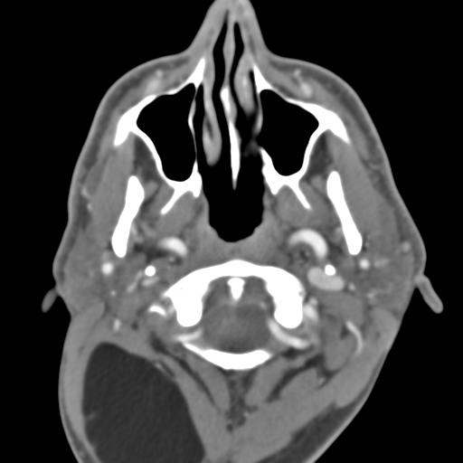 Anterior cerebral artery territory infarct (Radiopaedia 39327-41581 B 55).png