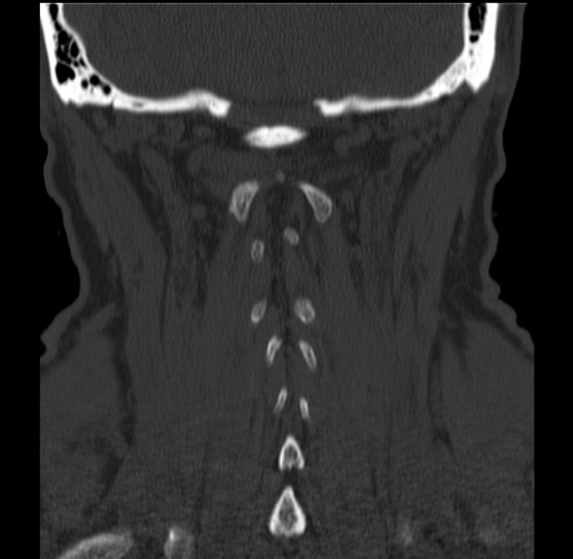 Anterior cervical postdiscectomy arthrodesis (Radiopaedia 32678-33646 Coronal bone window 56).jpg