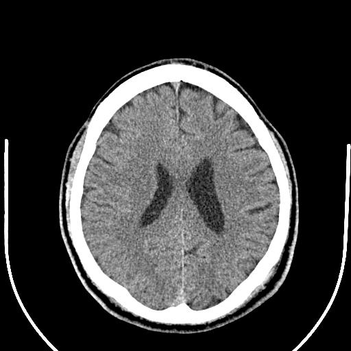 Anterior choroidal artery infarct (Radiopaedia 55106-61480 Axial non-contrast 38).jpg