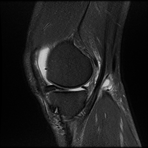 File:Anterior cruciate ligament graft tear and bucket-handle tear of medial meniscus (Radiopaedia 75867-87255 Sagittal PD fat sat 7).jpg