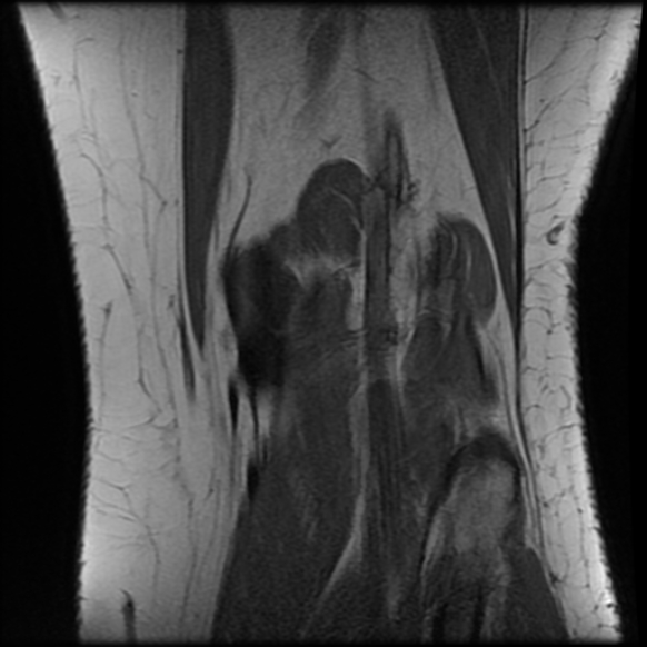 File:Anterior cruciate ligament tear, Wrisberg rip and bucket-handle tear of medial meniscus (Radiopaedia 75872-87266 Coronal T1 23).jpg