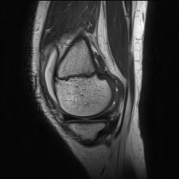File:Anterior cruciate ligament tear - pediatric (Radiopaedia 62152-70260 Sagittal PD 42).jpg