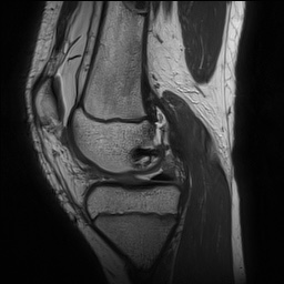 File:Anterior cruciate ligament tear - pediatric (Radiopaedia 62152-70260 Sagittal PD 69).jpg