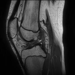 Anterior cruciate ligament tear - pediatric (Radiopaedia 62152-70260 Sagittal PD 94).jpg