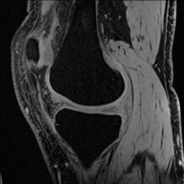 Anterior cruciate ligament tear - ramp lesion (Radiopaedia 71883-82322 Sagittal T1 vibe 92).jpg