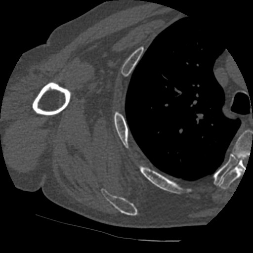 Anterior glenohumeral dislocation with Hill-Sachs lesion (Radiopaedia 62877-71249 Axial bone window 70).jpg