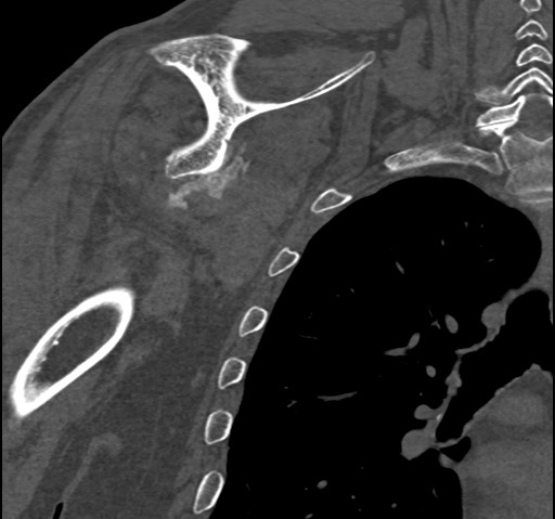 Anterior glenohumeral dislocation with Hill-Sachs lesion (Radiopaedia 62877-71249 Coronal bone window 69).jpg