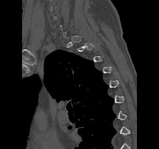 File:Anterior glenohumeral dislocation with Hill-Sachs lesion (Radiopaedia 62877-71249 Sagittal bone window 73).jpg