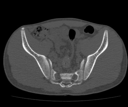Anterior inferior iliac spine avulsion fracture (Radiopaedia 81312-94999 Axial bone window 35).jpg