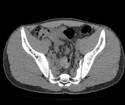 Anterior inferior iliac spine avulsion fracture (Radiopaedia 81312-94999 Axial non-contrast 36).jpg