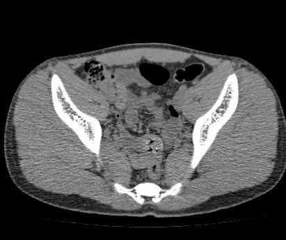 File:Anterior inferior iliac spine avulsion fracture (Radiopaedia 81312-94999 Axial non-contrast 39).jpg