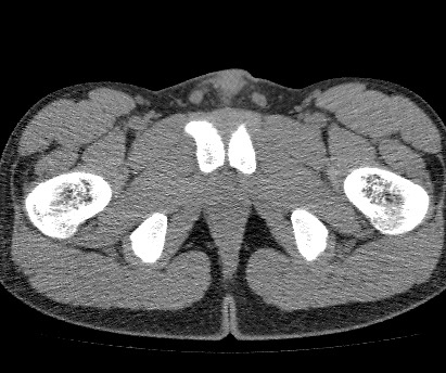 Anterior inferior iliac spine avulsion fracture (Radiopaedia 81312-94999 Axial non-contrast 66).jpg