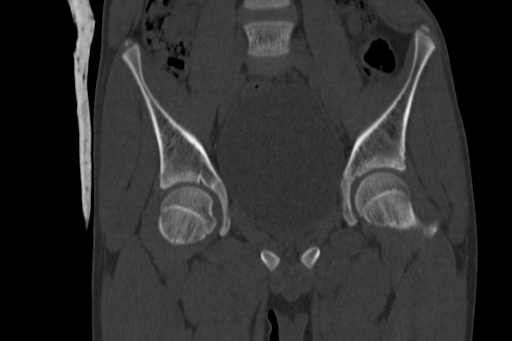 Anterior inferior iliac spine avulsion injury (Radiopaedia 88666-105376 Coronal bone window 31).jpg