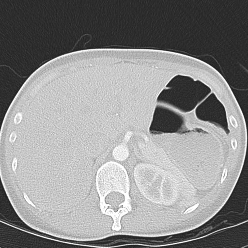 Anterior mediastinal lymphoma (Radiopaedia 29556-30061 Axial lung window 56).jpg