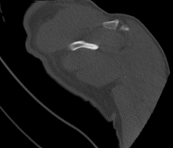 Anterior shoulder dislocation with Hill-Sachs and bony Bankart lesions (Radiopaedia 40424-42974 Coronal bone window 39).png