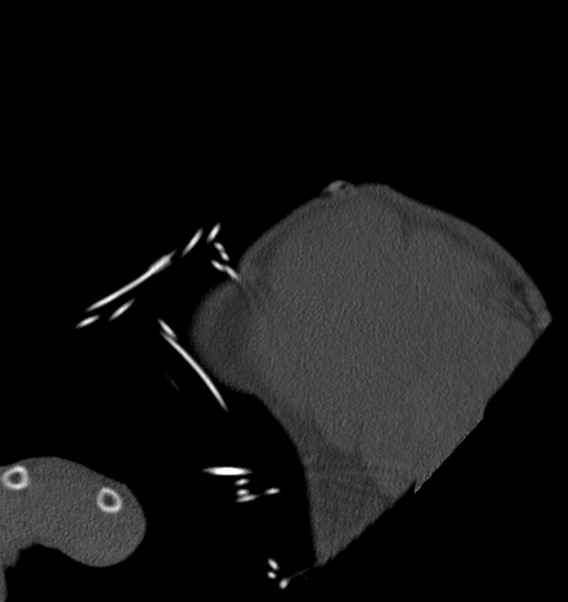 Anterior shoulder dislocation with Hill-Sachs and bony Bankart lesions (Radiopaedia 40424-42974 Sagittal bone window 6).png