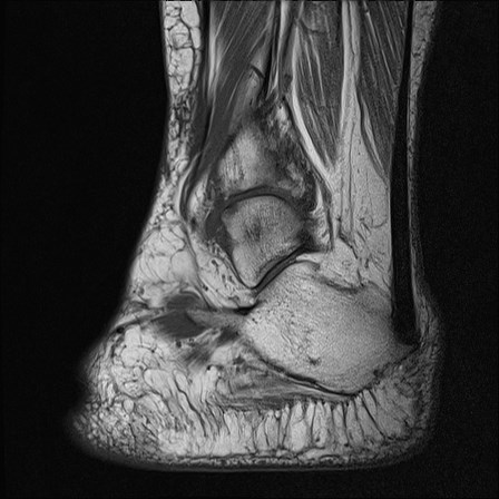 File:Anterior talofibular ligament injury - rupture with soft-tissue impingement (Radiopaedia 38765-40928 Sagittal PD 15).jpg