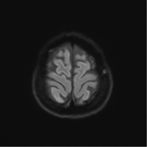 File:Anterior temporal lobe perivascular space (Radiopaedia 40946-43650 Axial DWI 52).png