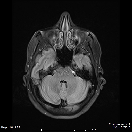 File:Anterior temporal lobe perivascular space (Radiopaedia 88283-104914 Axial FLAIR 10).jpg