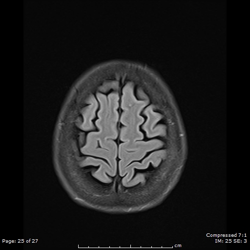 File:Anterior temporal lobe perivascular space (Radiopaedia 88283-104914 Axial FLAIR 25).jpg