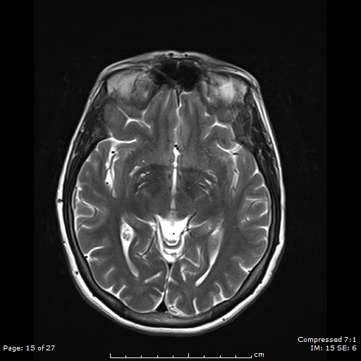 File:Anterior temporal lobe perivascular space (Radiopaedia 88283-104914 Axial T2 15).jpg