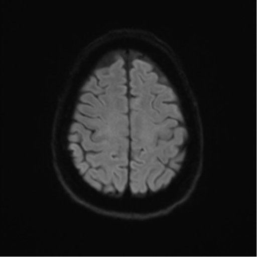 Anterior temporal pole cysts (Radiopaedia 46629-51102 Axial DWI 49).png