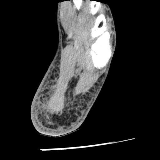 Anterior tibial artery false aneurysm (Radiopaedia 88984-105809 A 226).jpg