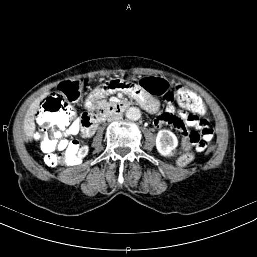 File:Aortic aneurysm and Lemmel syndrome (Radiopaedia 86499-102554 A 43).jpg